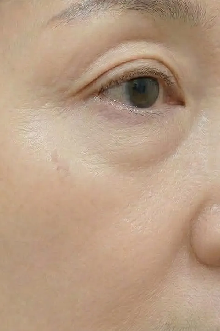 듀얼토닝 10회
+ 사마귀제거 1회 after